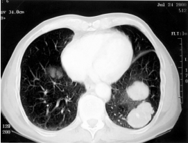 MFH sarcoma in lungs omega 3