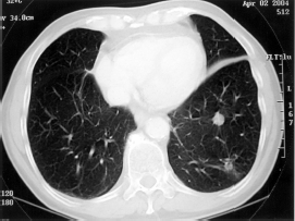 MFH sarcoma in lungs omega 3